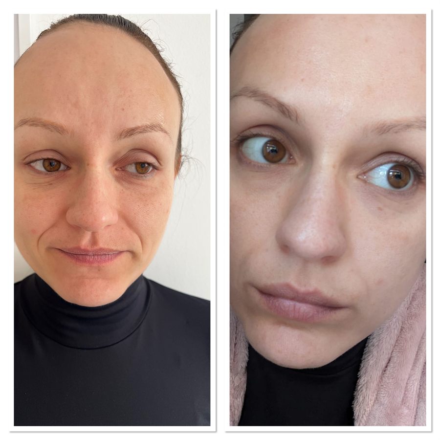 BT Rejuvenation before and after result 10