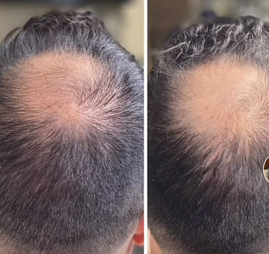 BT Rejuvenation before and after result 11