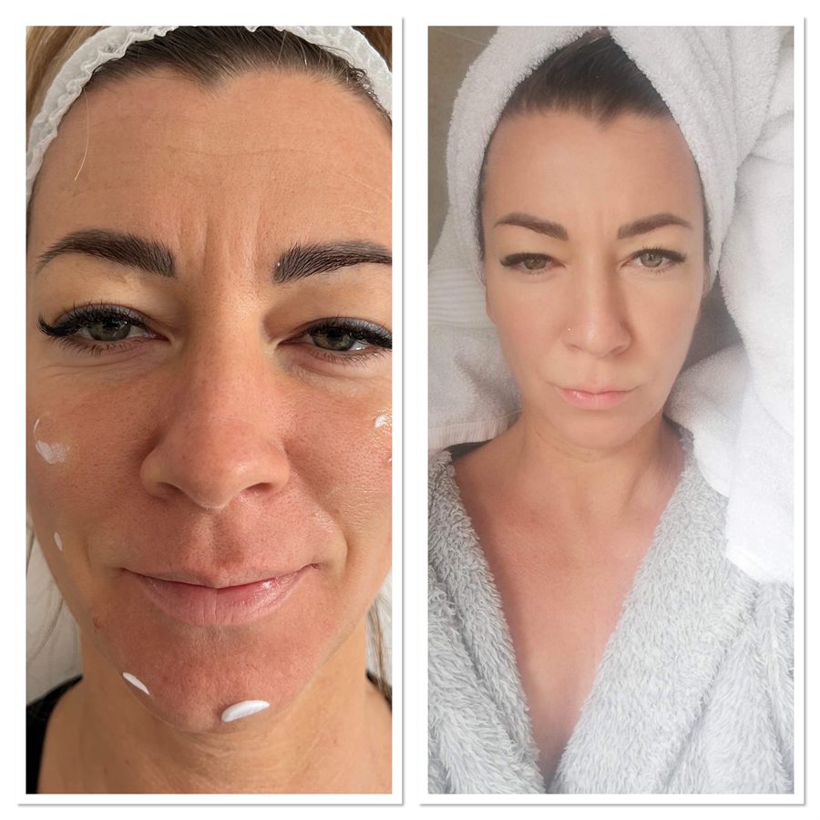 BT Rejuvenation before and after result 12