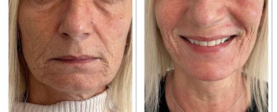 BT Rejuvenation before and after result 13