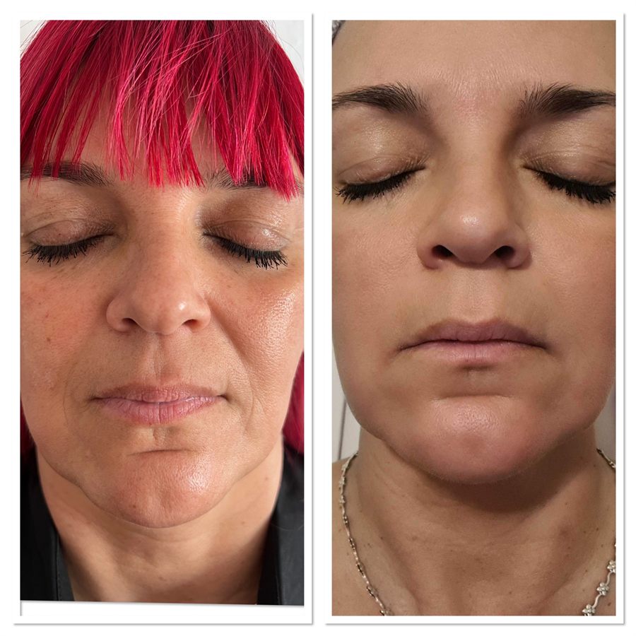 BT Rejuvenation before and after result 14