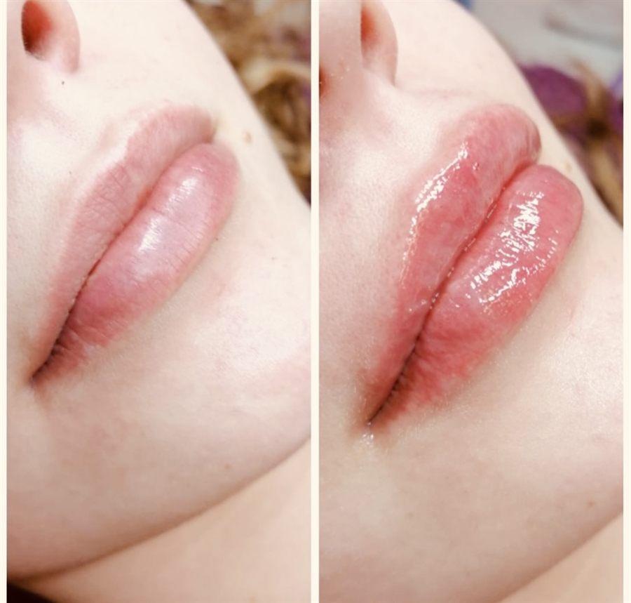 BT Rejuvenation before and after result 15