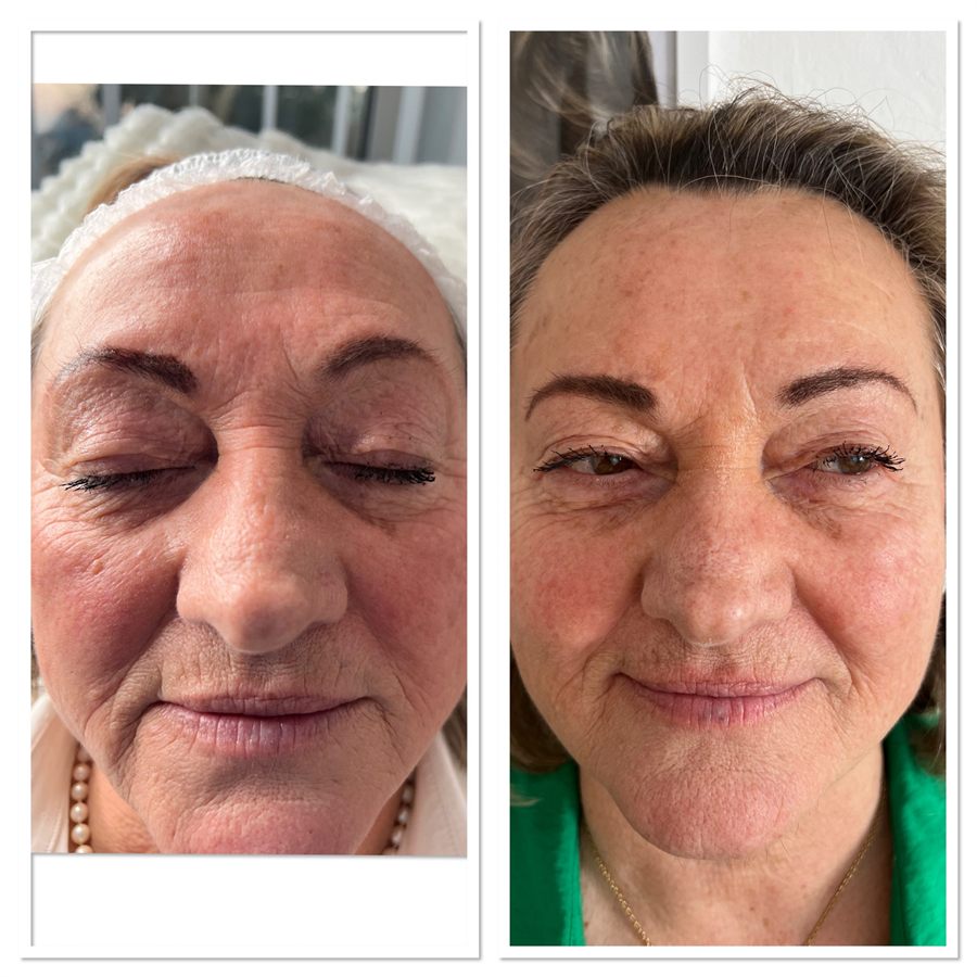 BT Rejuvenation before and after result 16