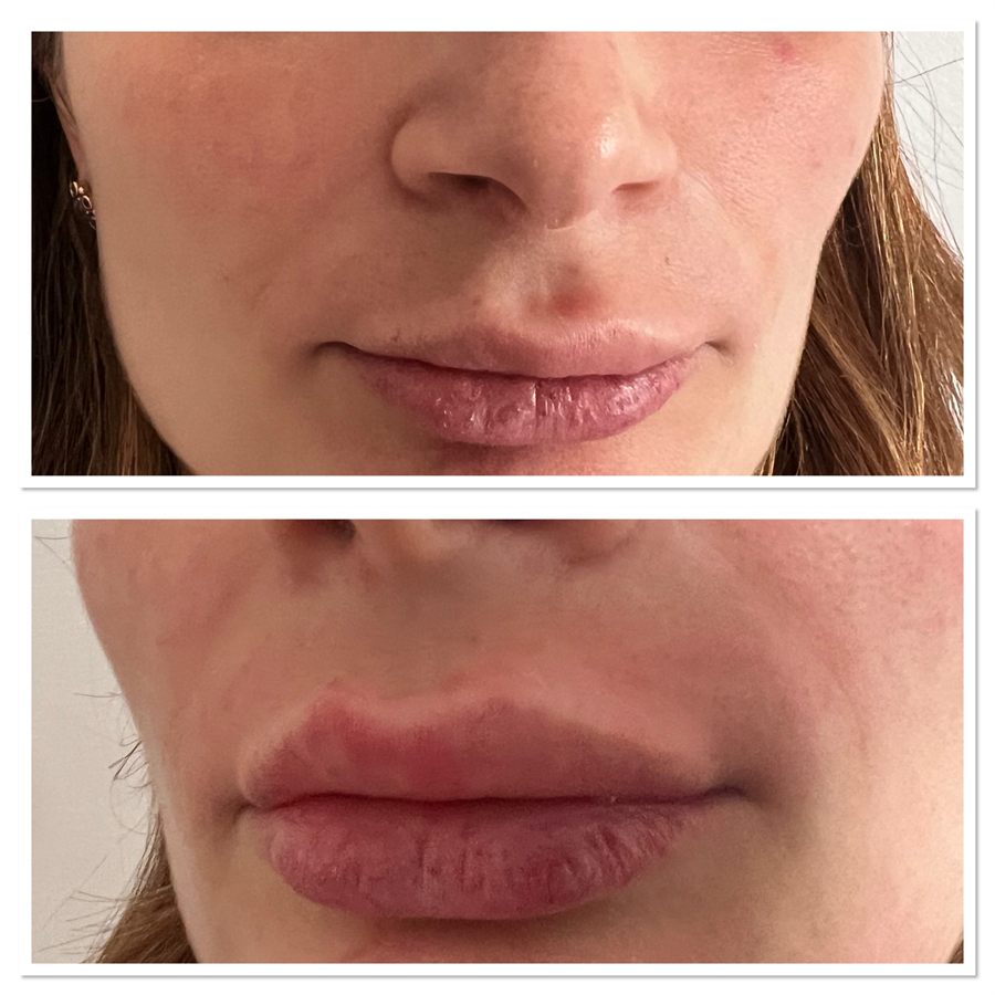 BT Rejuvenation before and after result 18