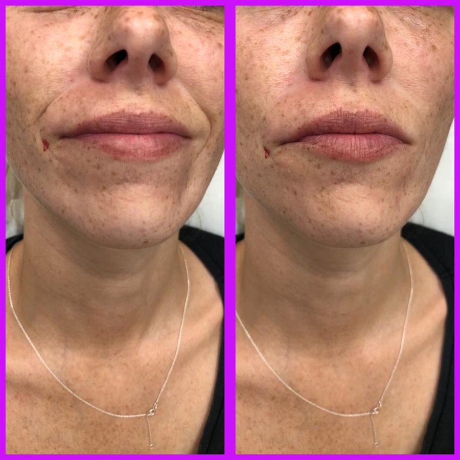 BT Rejuvenation before and after result 19
