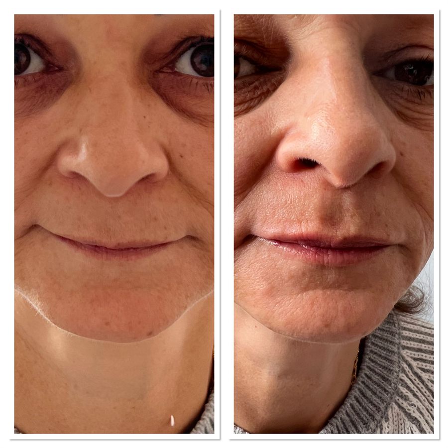 BT Rejuvenation before and after result 21