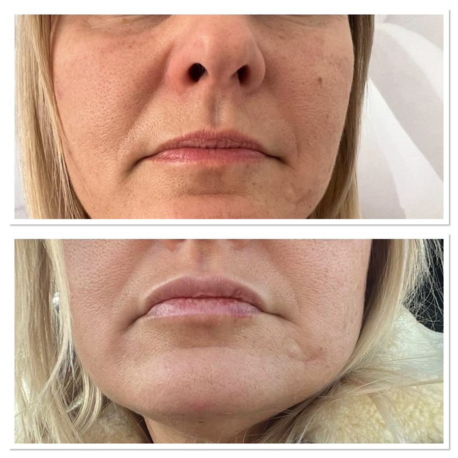 BT Rejuvenation before and after result 22