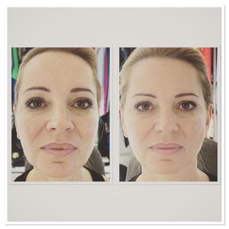 BT Rejuvenation before and after result 23