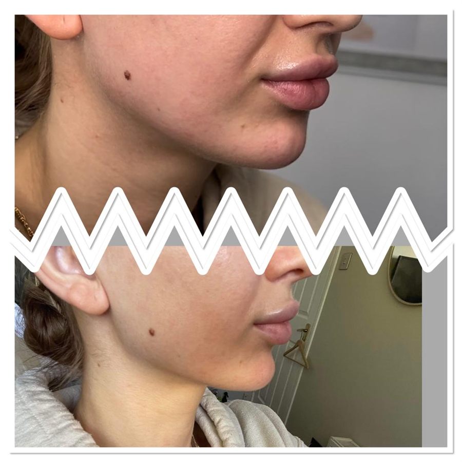 BT Rejuvenation before and after result 25