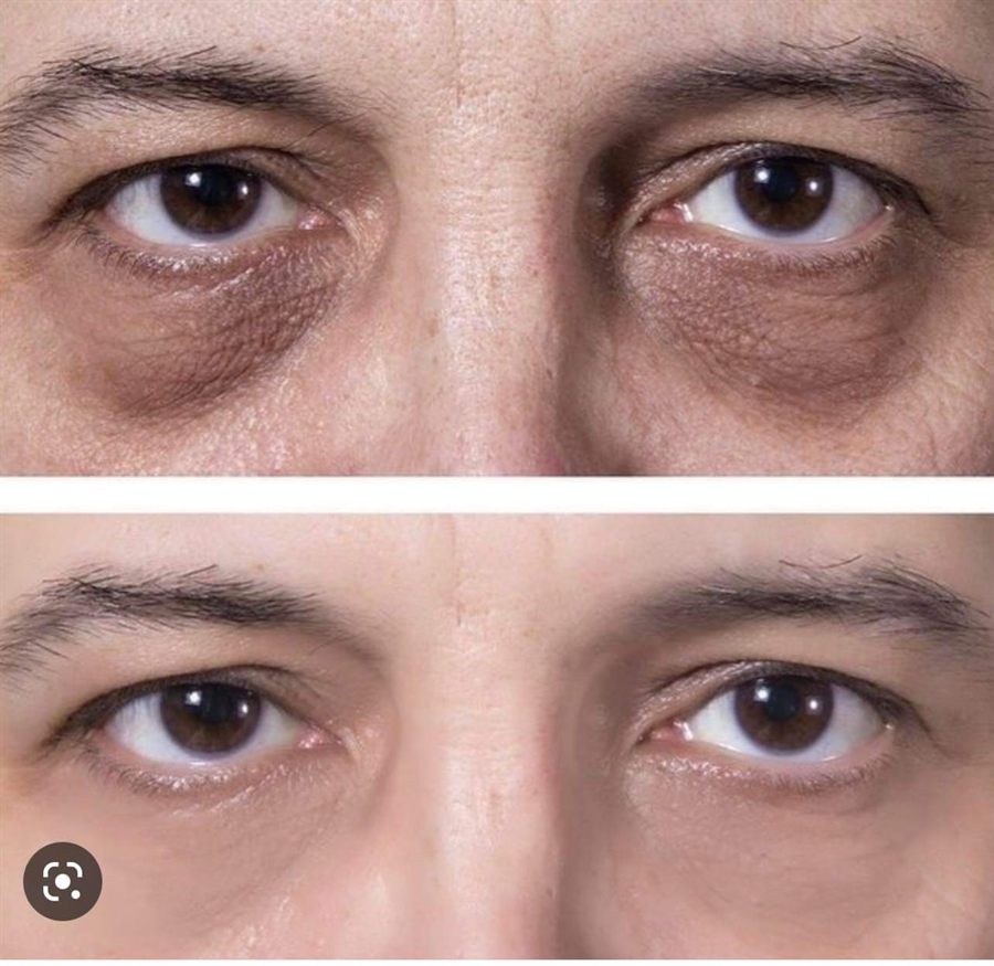BT Rejuvenation before and after result 26