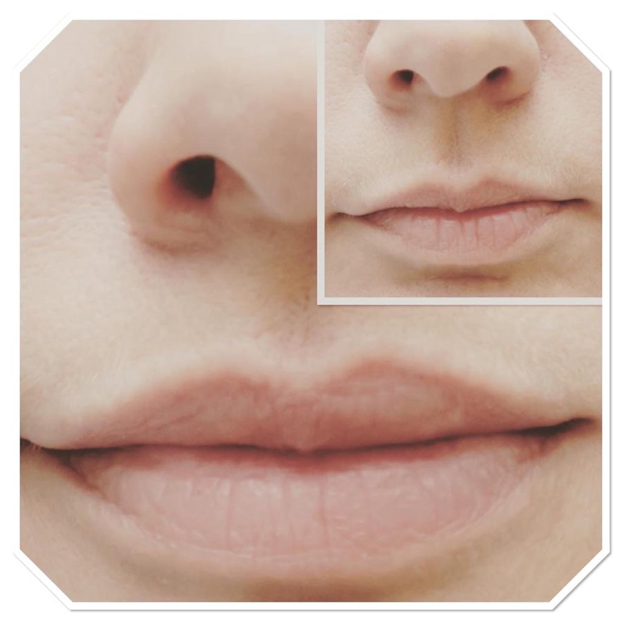 BT Rejuvenation before and after result 27