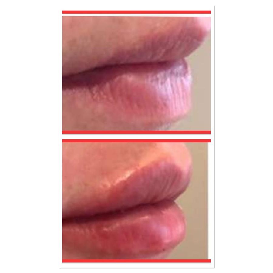 BT Rejuvenation before and after result 29