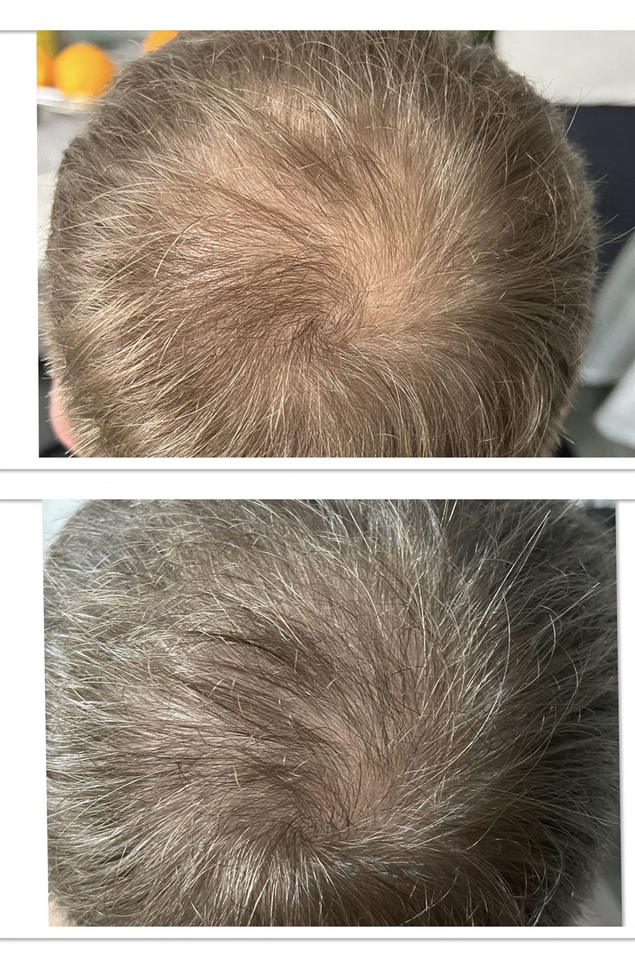 BT Rejuvenation before and after result 30