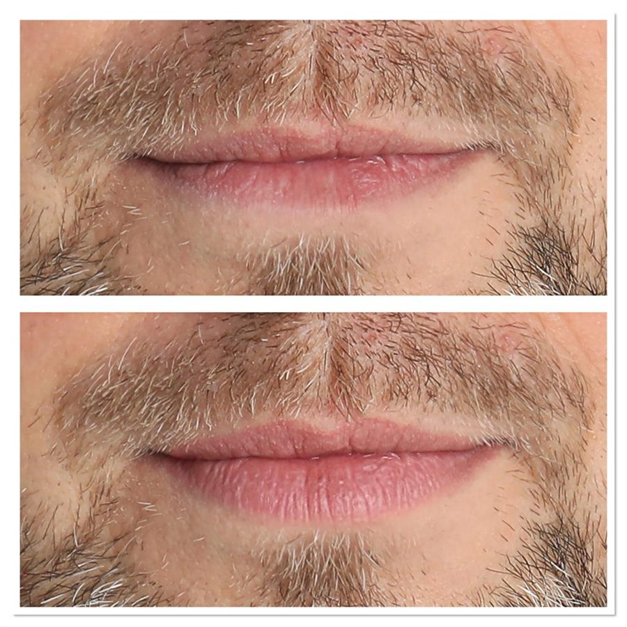 BT Rejuvenation before and after result 31
