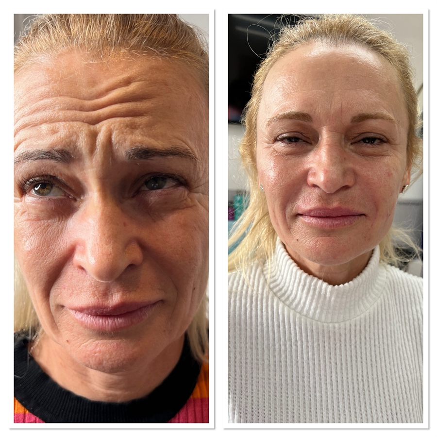BT Rejuvenation before and after result 32