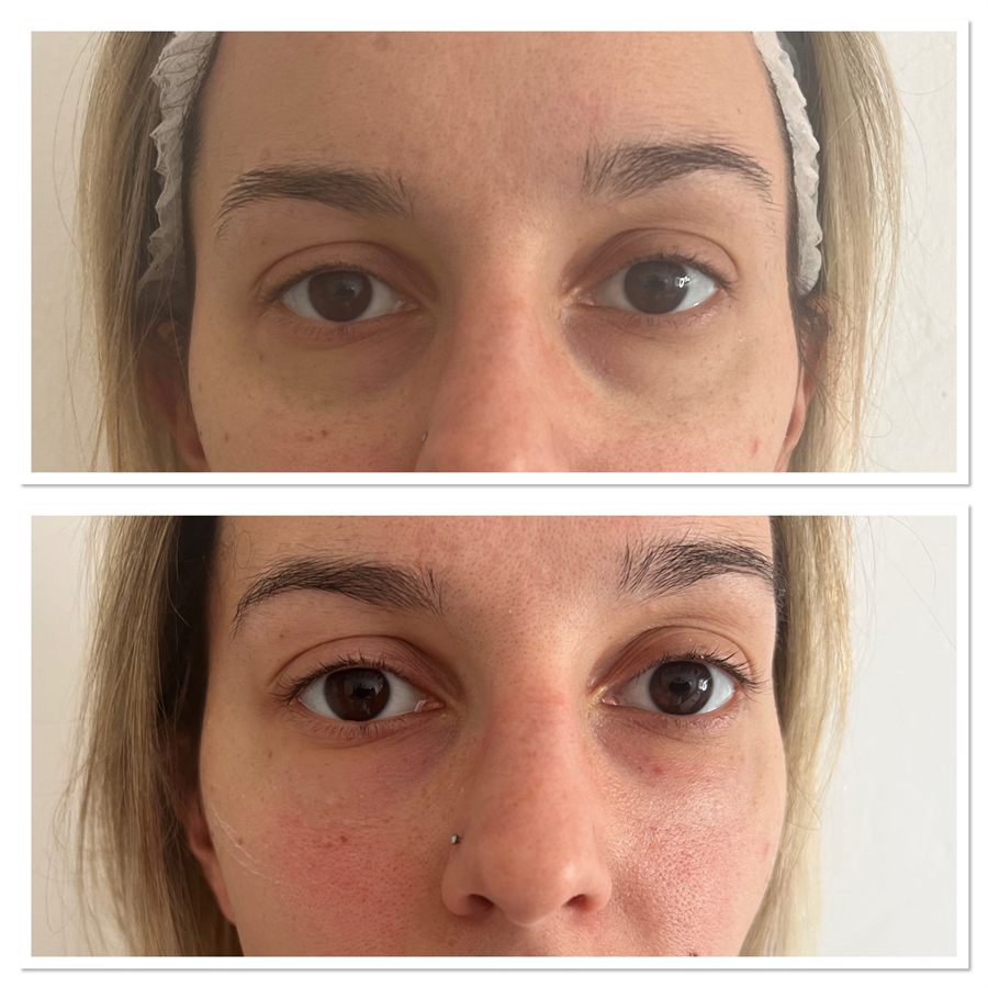 BT Rejuvenation before and after result 34