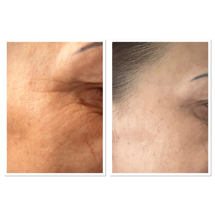BT Rejuvenation before and after result 36
