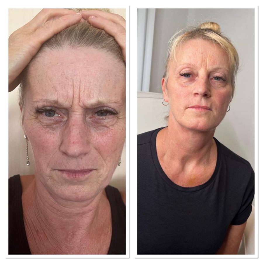 BT Rejuvenation before and after result 37