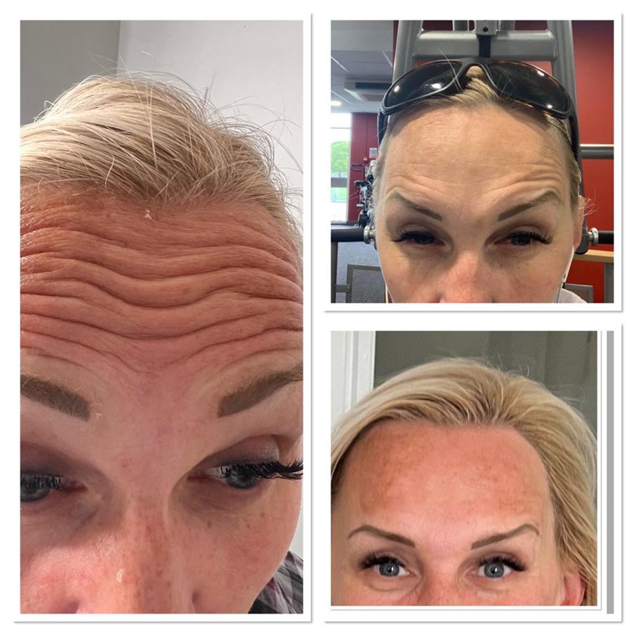 BT Rejuvenation before and after result 39