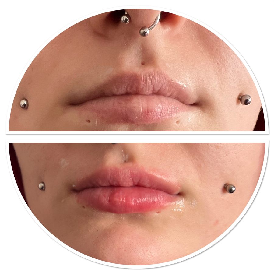 BT Rejuvenation before and after result 40