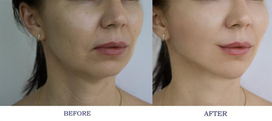 BT Rejuvenation before and after result 41