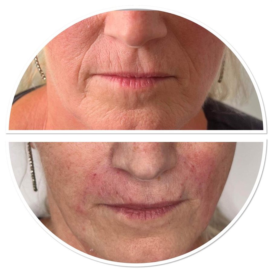 BT Rejuvenation before and after result 43