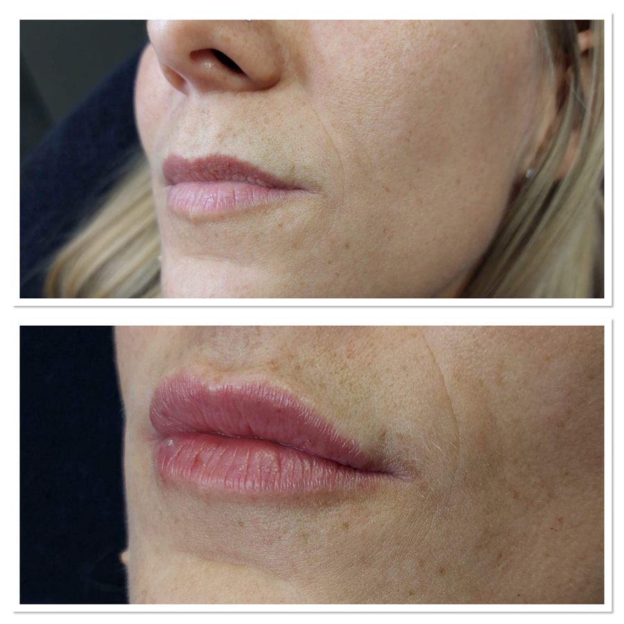 BT Rejuvenation before and after result 44