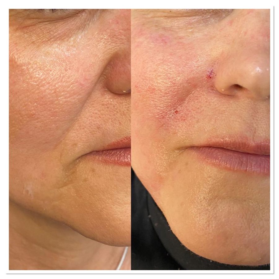 BT Rejuvenation before and after result 45