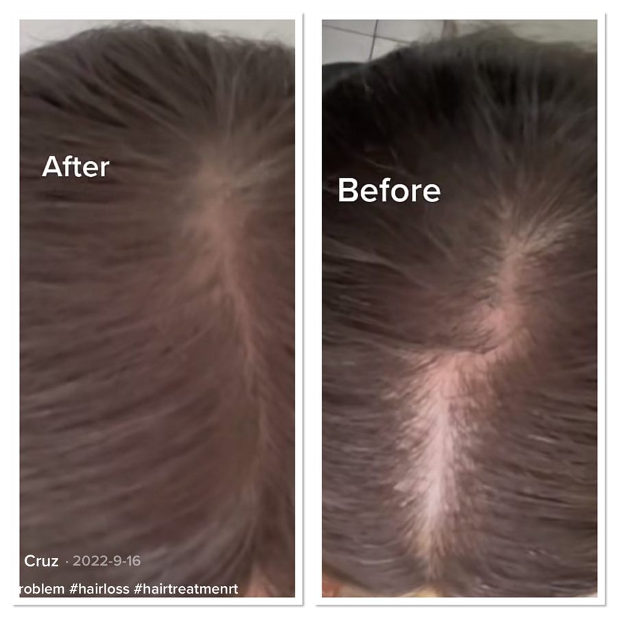 BT Rejuvenation before and after result 46