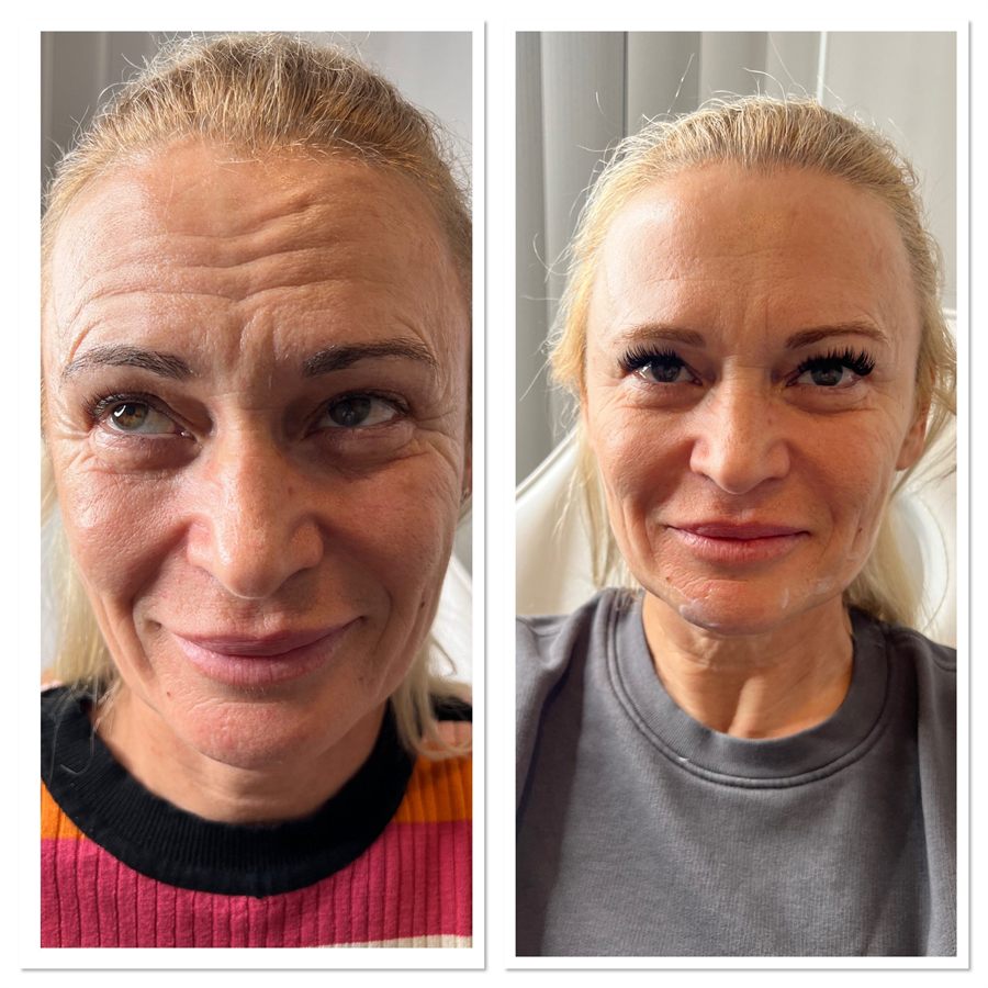BT Rejuvenation before and after result 48