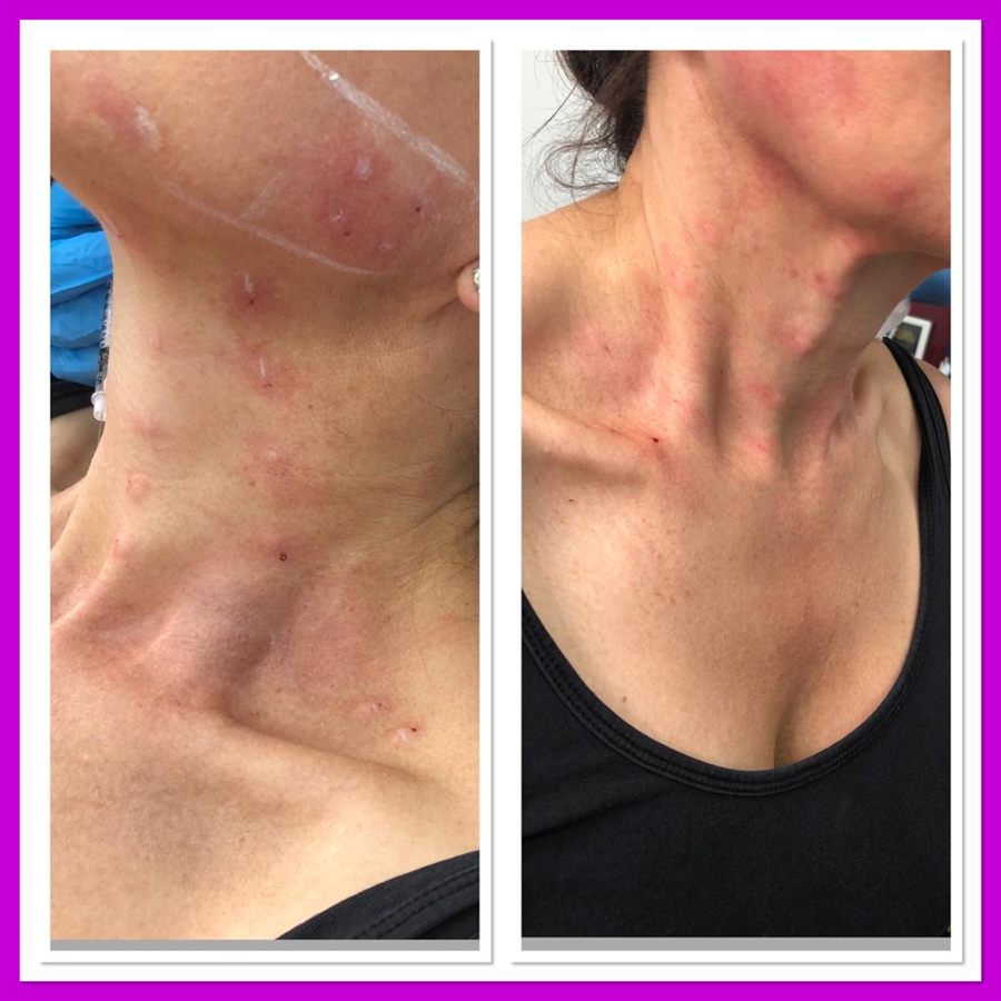 BT Rejuvenation before and after result 49