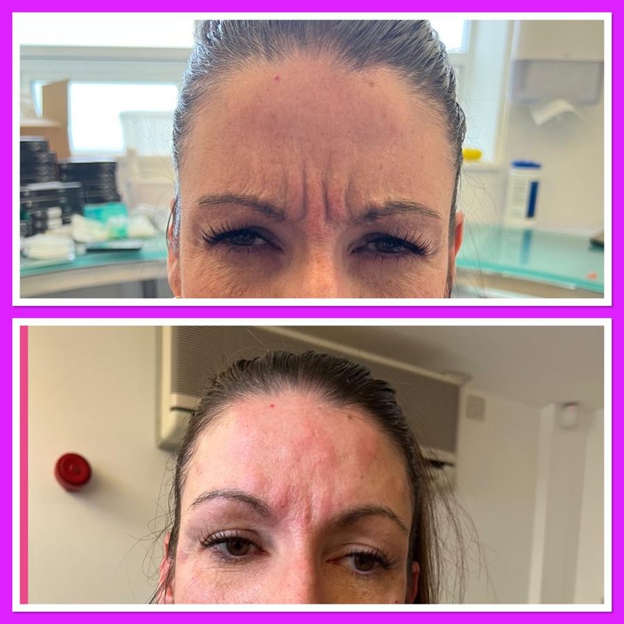 BT Rejuvenation before and after result 5