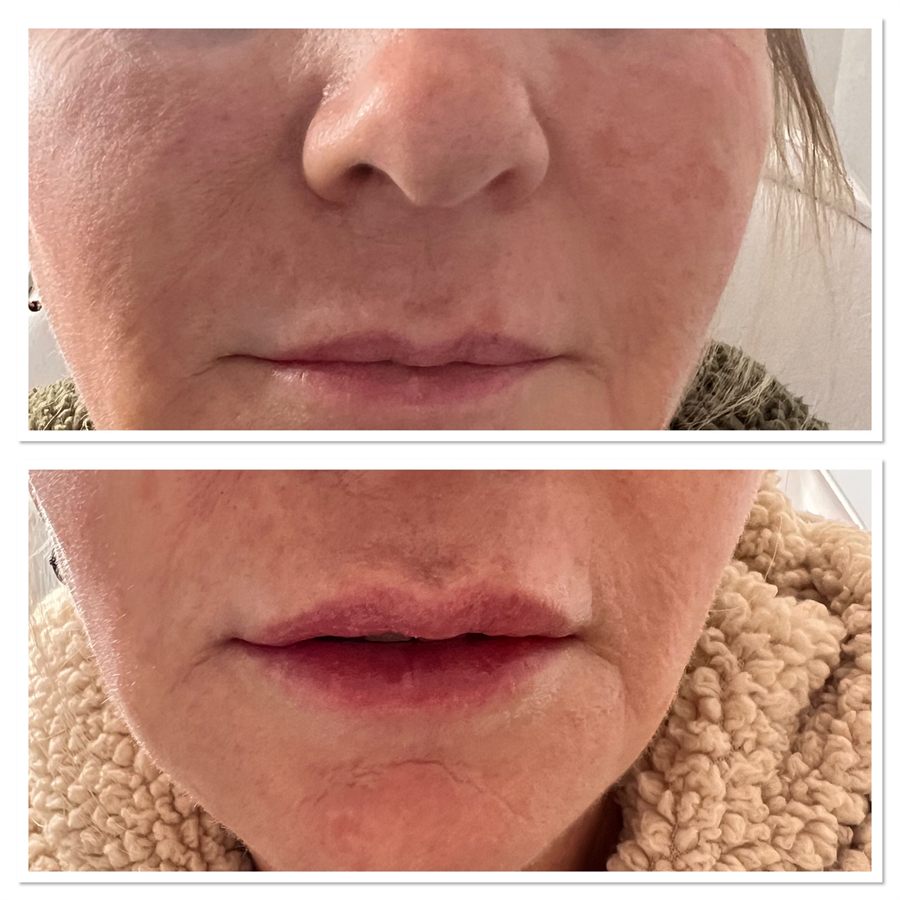 BT Rejuvenation before and after result 50