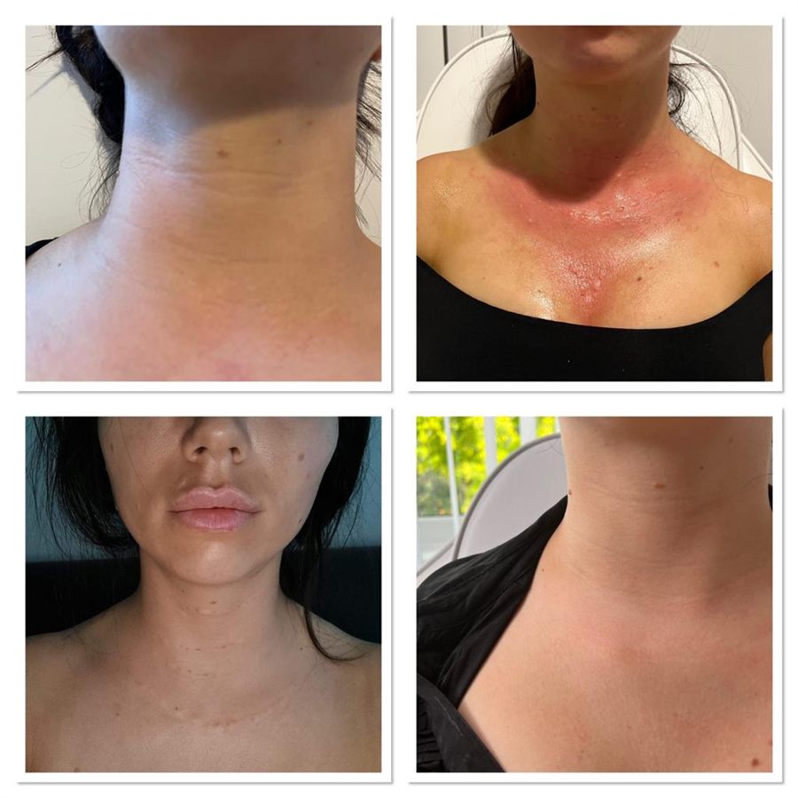 BT Rejuvenation before and after result 51