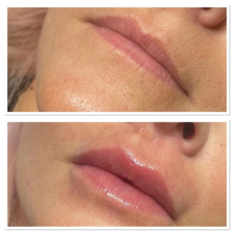 BT Rejuvenation before and after result 52