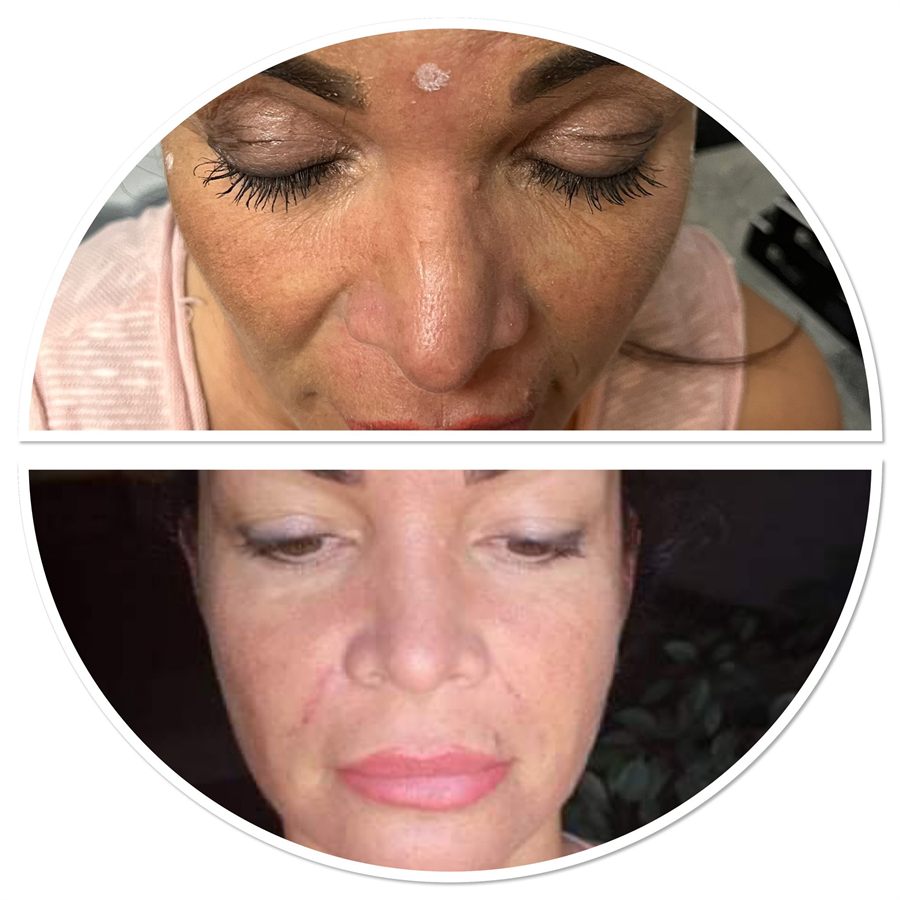 BT Rejuvenation before and after result 53