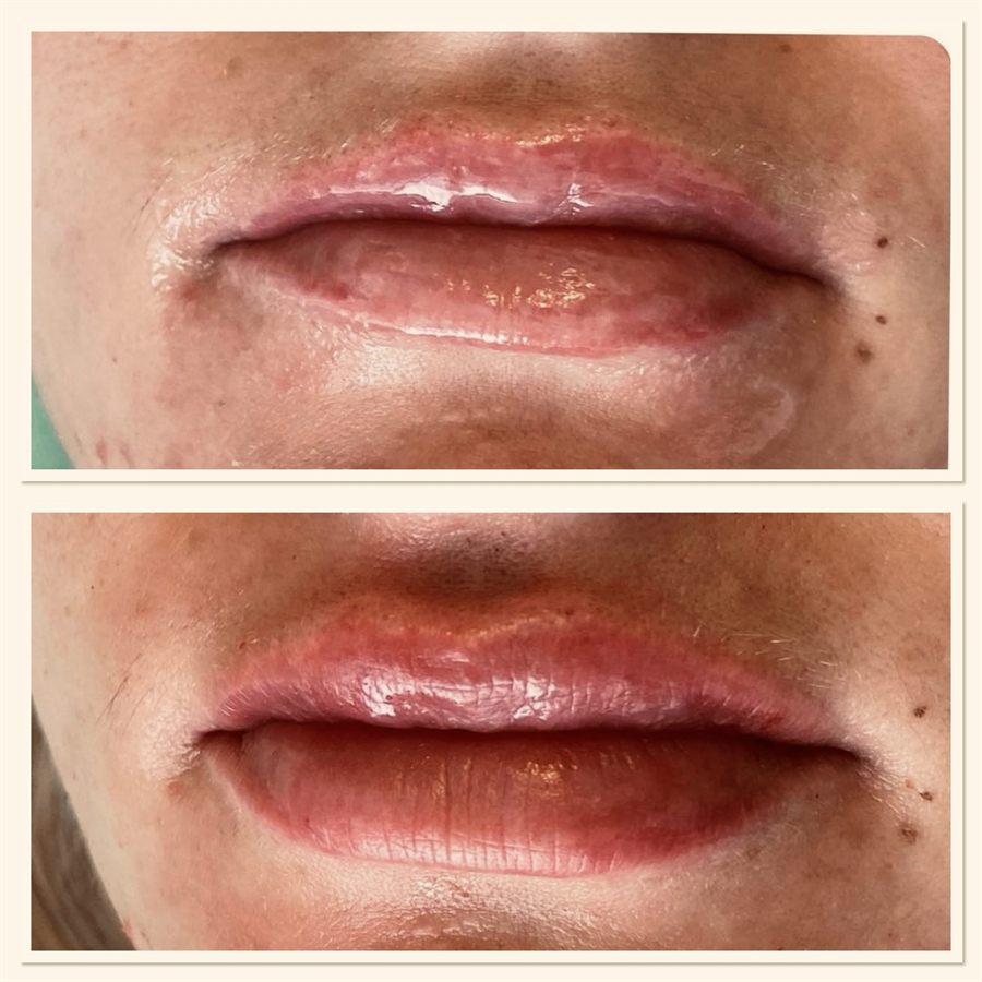 BT Rejuvenation before and after result 54