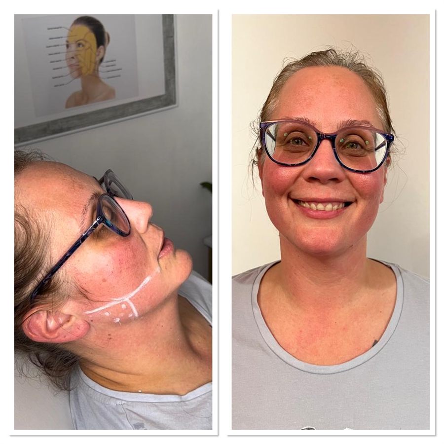 BT Rejuvenation before and after result 55
