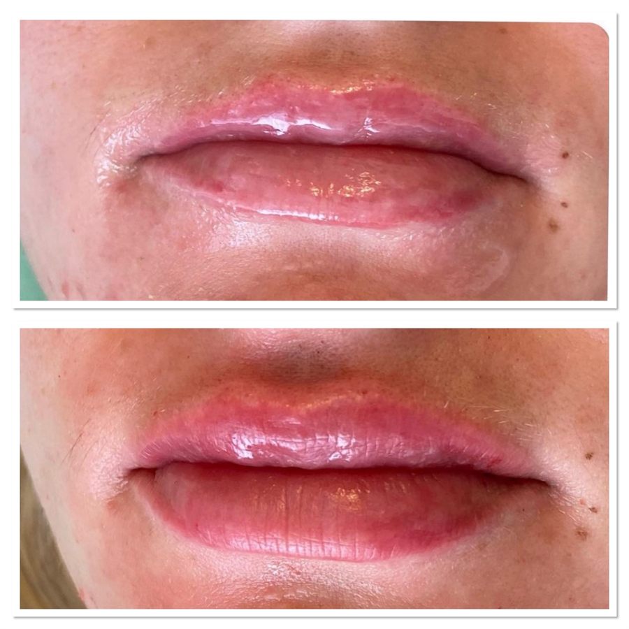 BT Rejuvenation before and after result 56