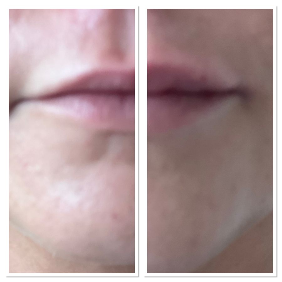 BT Rejuvenation before and after result 57