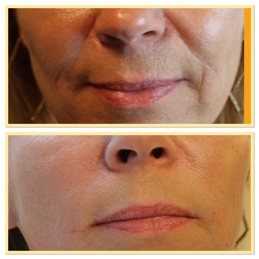 BT Rejuvenation before and after result 58
