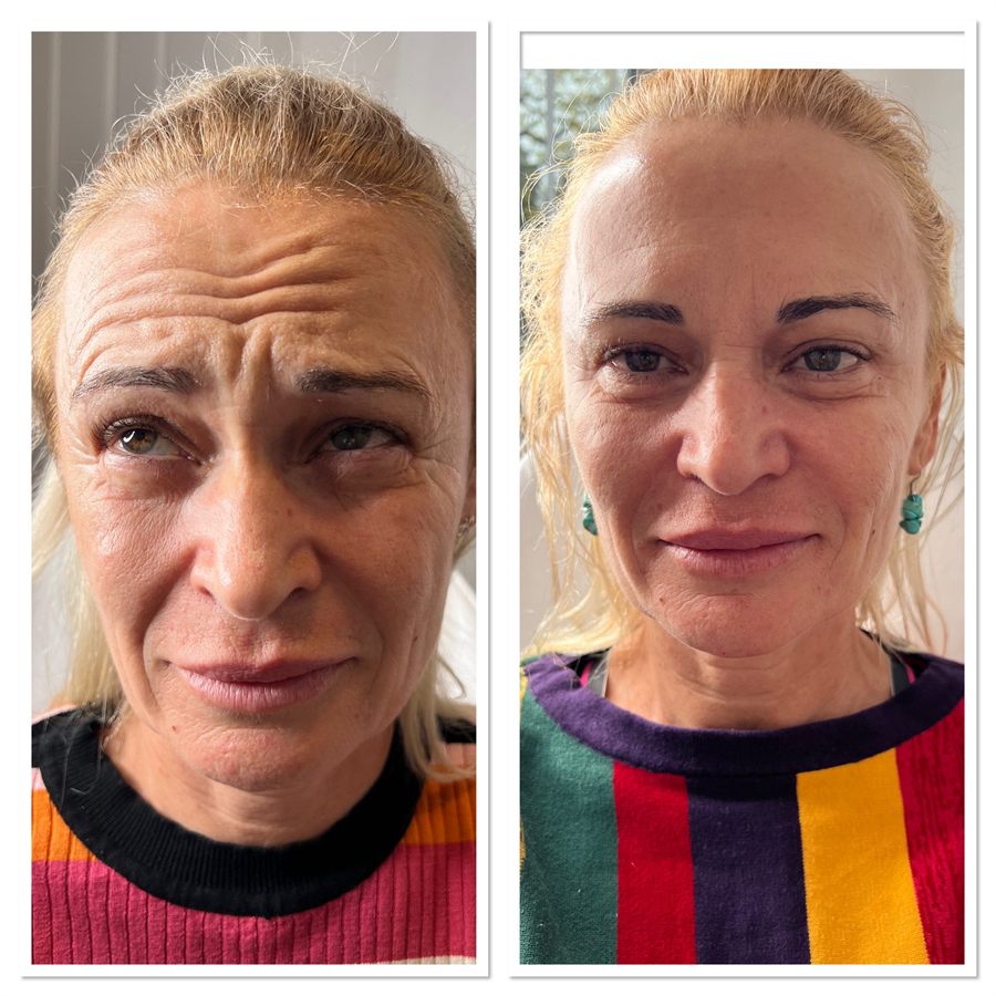 BT Rejuvenation before and after result 59