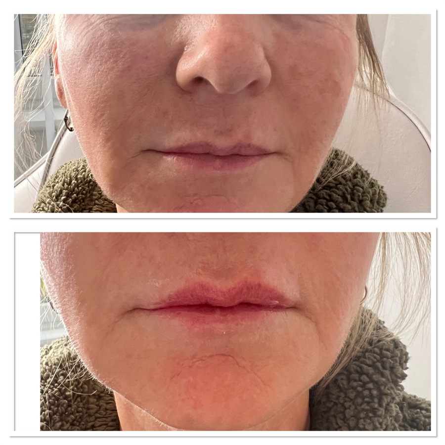 BT Rejuvenation before and after result 60