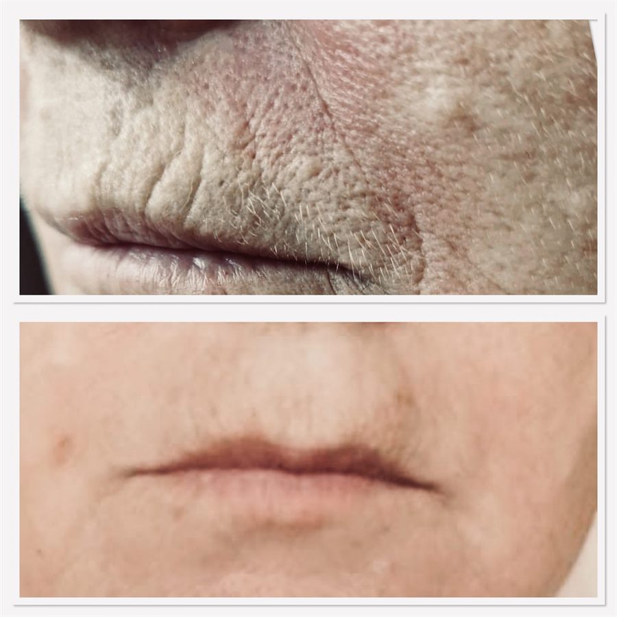 BT Rejuvenation before and after result 62