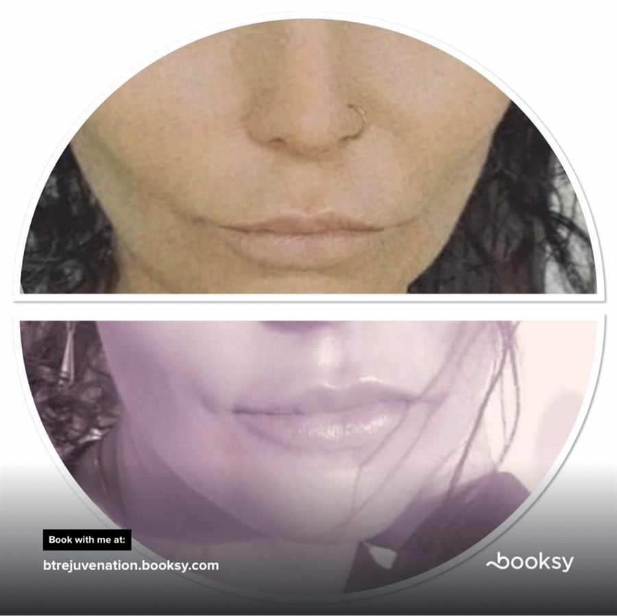 BT Rejuvenation before and after result 63