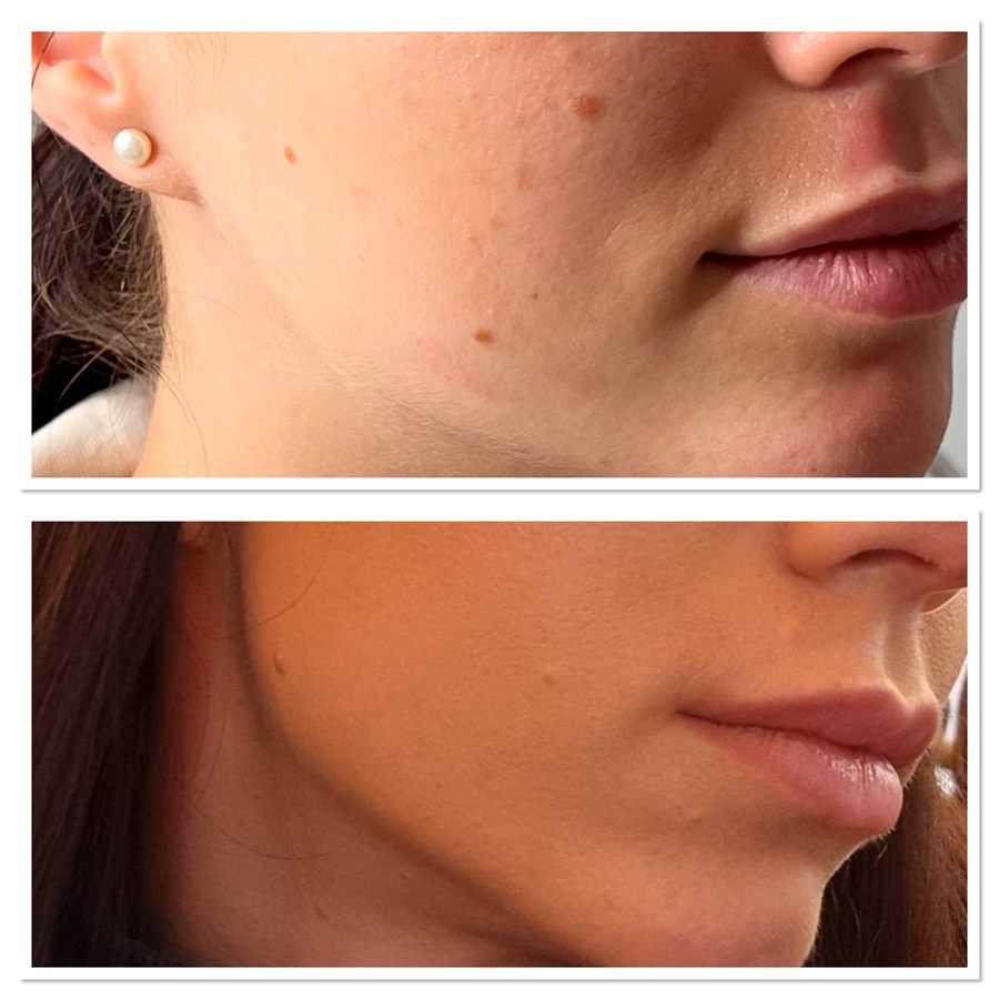 BT Rejuvenation before and after result 64