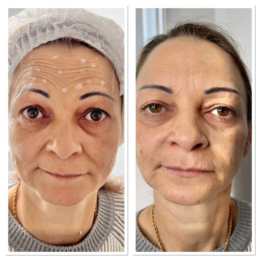 BT Rejuvenation before and after result 65