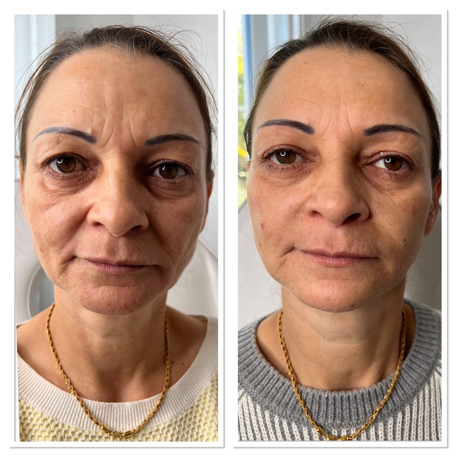 BT Rejuvenation before and after result 66