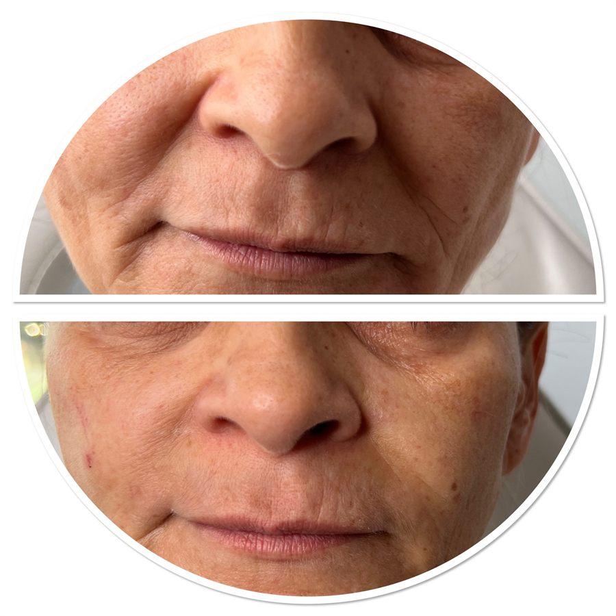 BT Rejuvenation before and after result 67