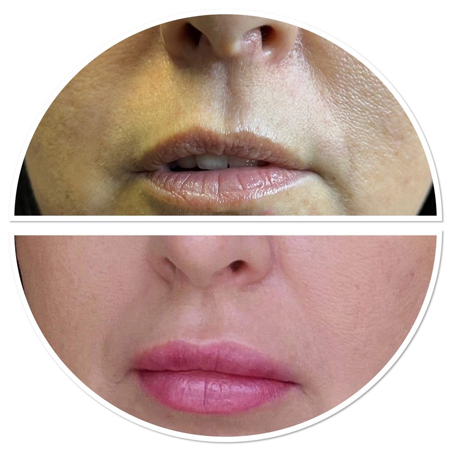 BT Rejuvenation before and after result 68